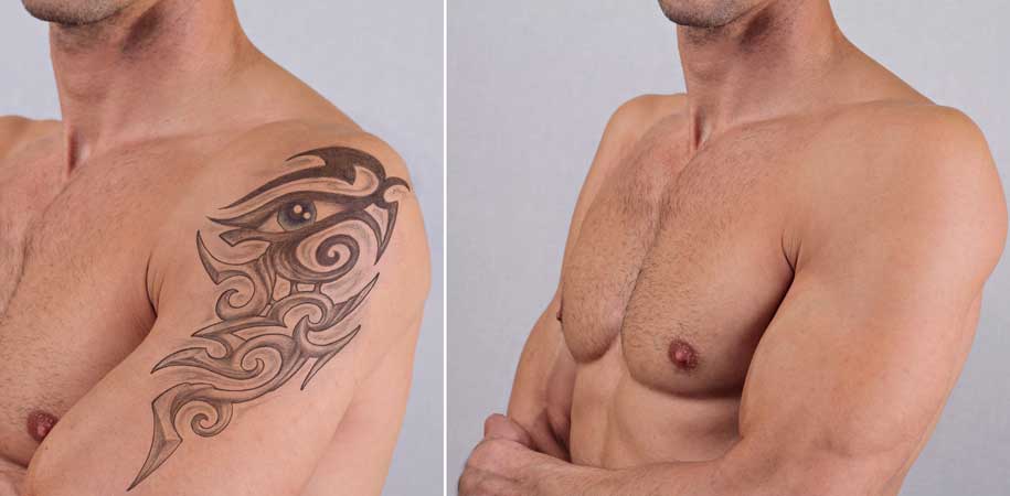 Laser Tattoo Removal