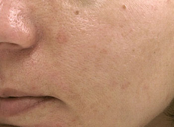 Melasma Treatment