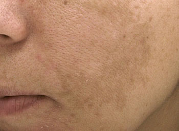 Melasma Treatment