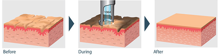 Hollywood Laser Peel