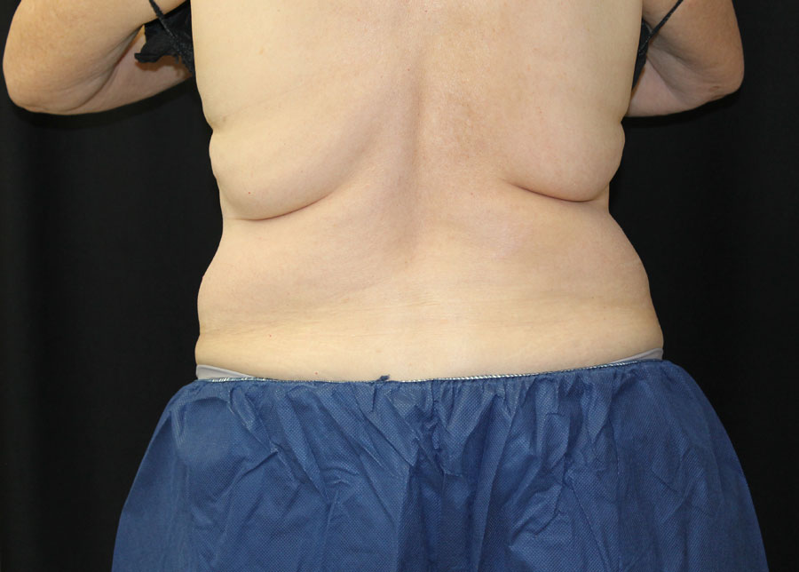 CoolSculpting for Fat Removal  La Nouvelle Medical Spa, Oxnard