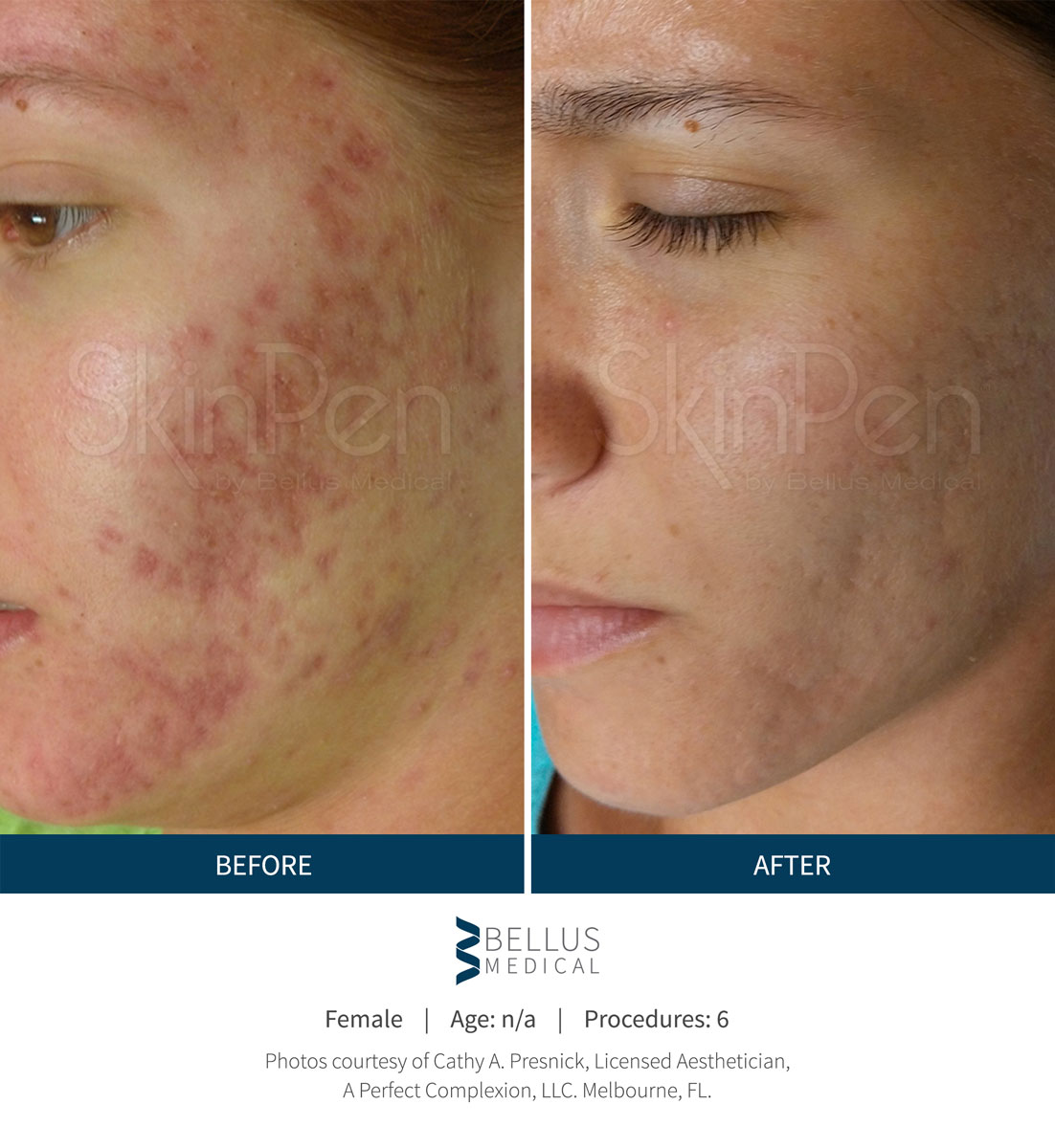 microneedling-with-prp-oasis-med-spa-wsnm-albuquerque-nm