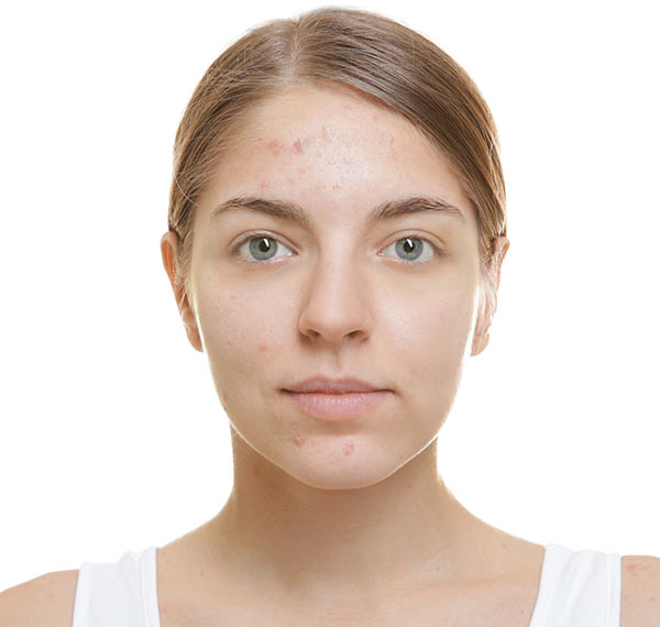 teen acne facials albuquerque